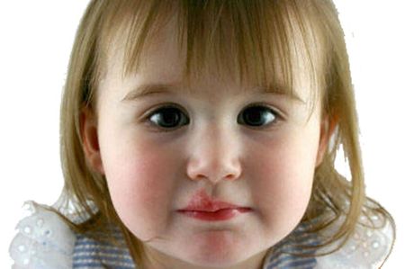 чем лечить герпес на губе у ребенка