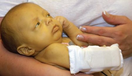 желтуха у новорожденных причины лечение