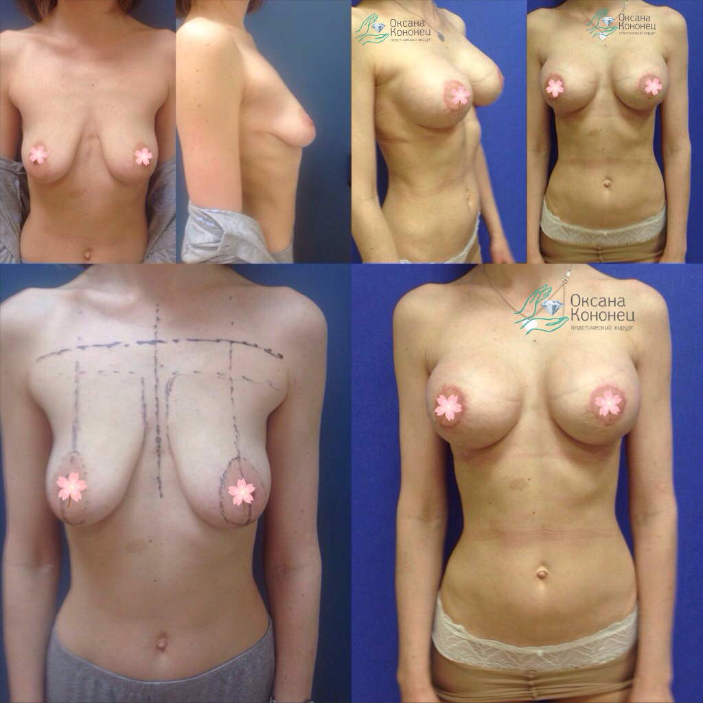 уменьшение груди у женщин фото 91