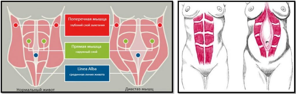 Диастаз прямых мышц живота фото